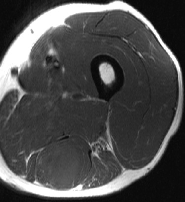 Figure 2 for case Adenocarcinoma lung metastasis
